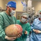  Usunięty guz ważył aż 20 kilogram&oacute;w 
